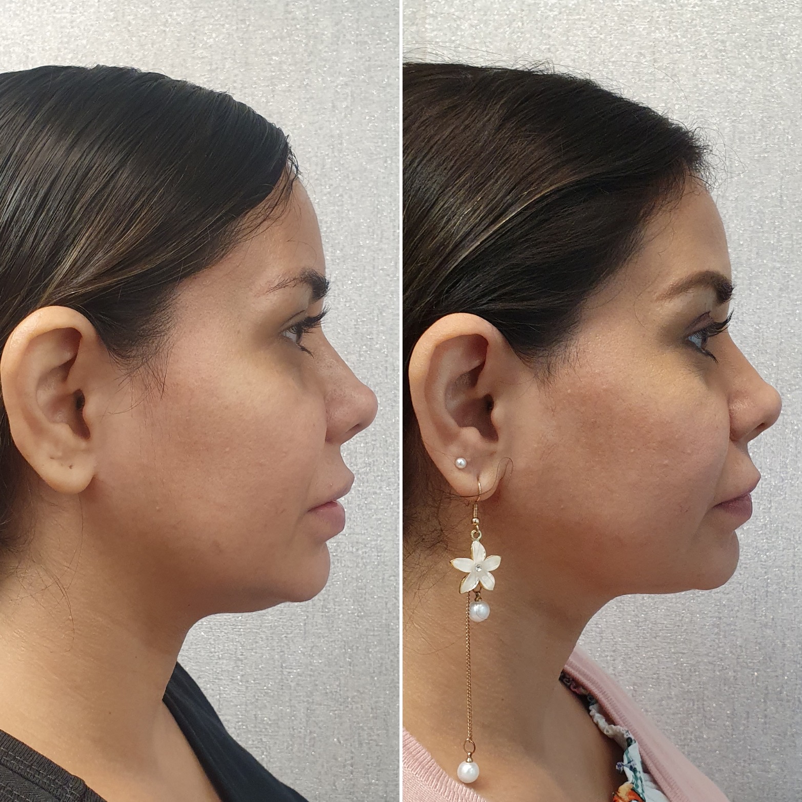 Antes y después · Liposucción Cervical · Perfil · definición cervical postoperatoria