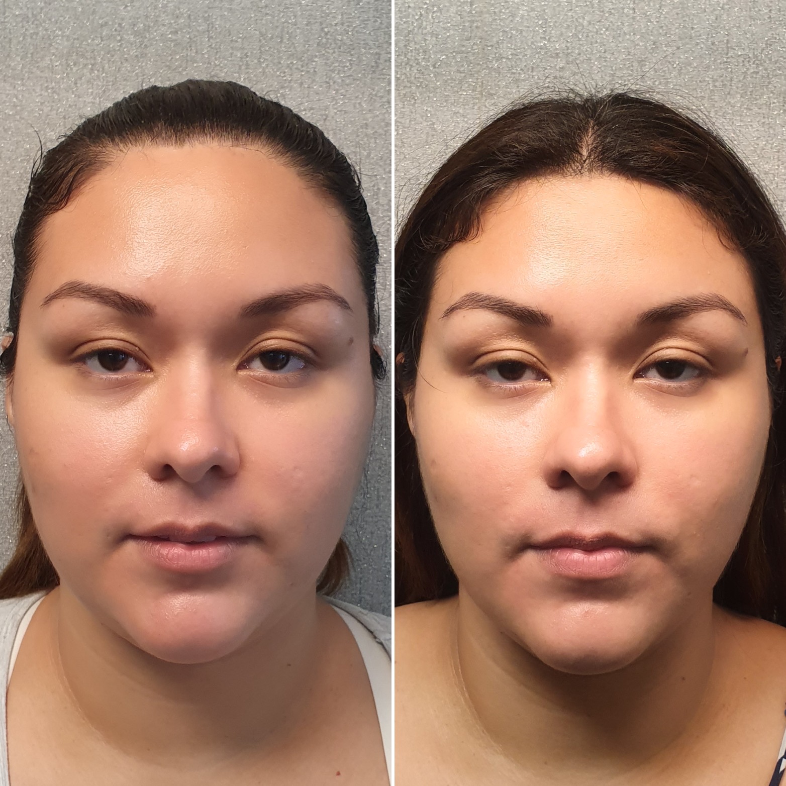 Antes y después · Liposucción Cervical · Frontal · armonía del contorno facial