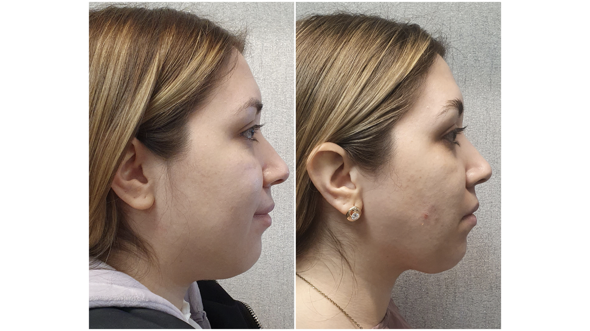 Antes y después · Liposucción Cervical · Perfil · armonía del ángulo cervical