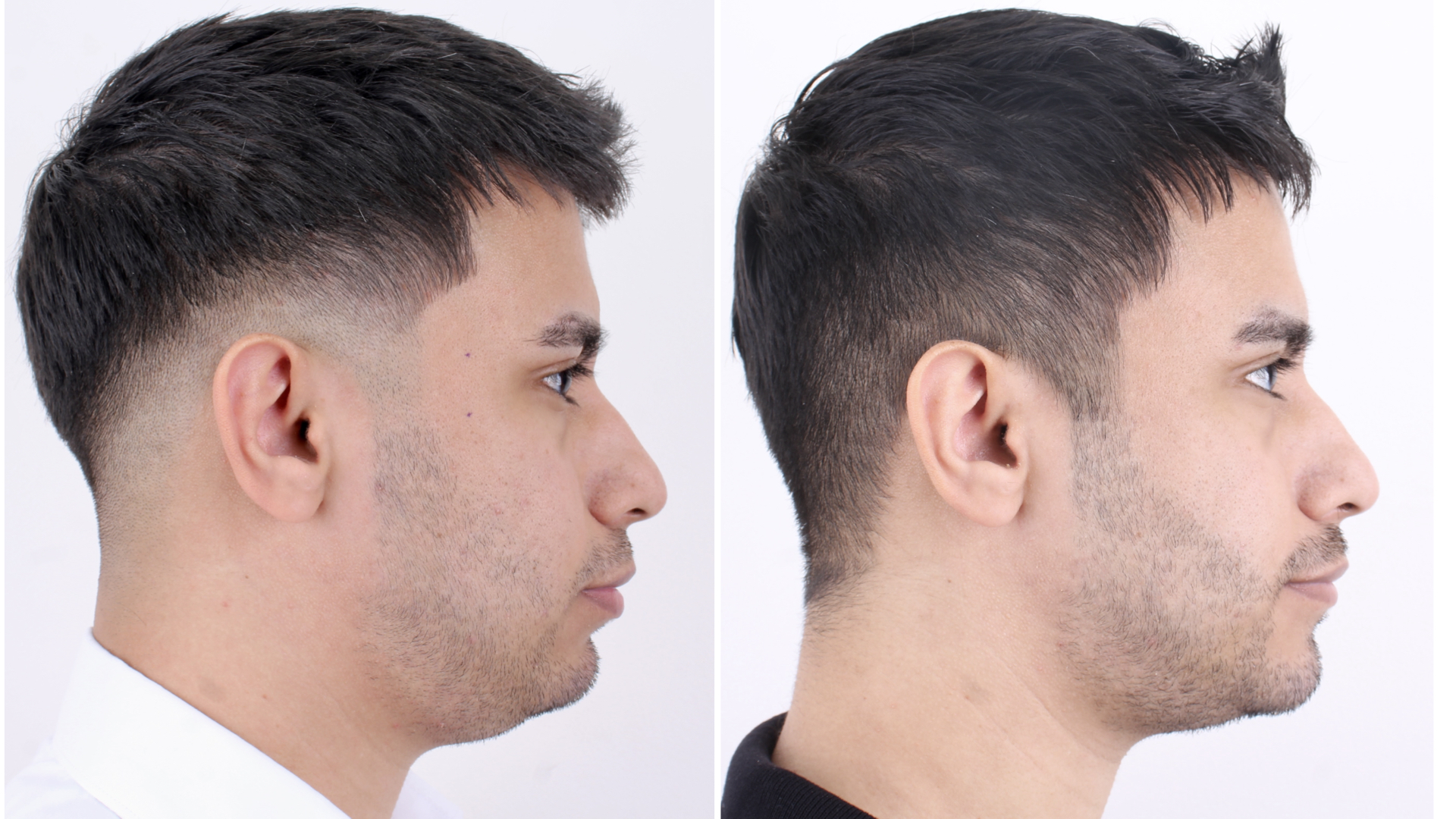 Antes y después · Liposucción Cervical · Perfil antes y después: proyección del mentón y definición del ángulo cervicomandibular.