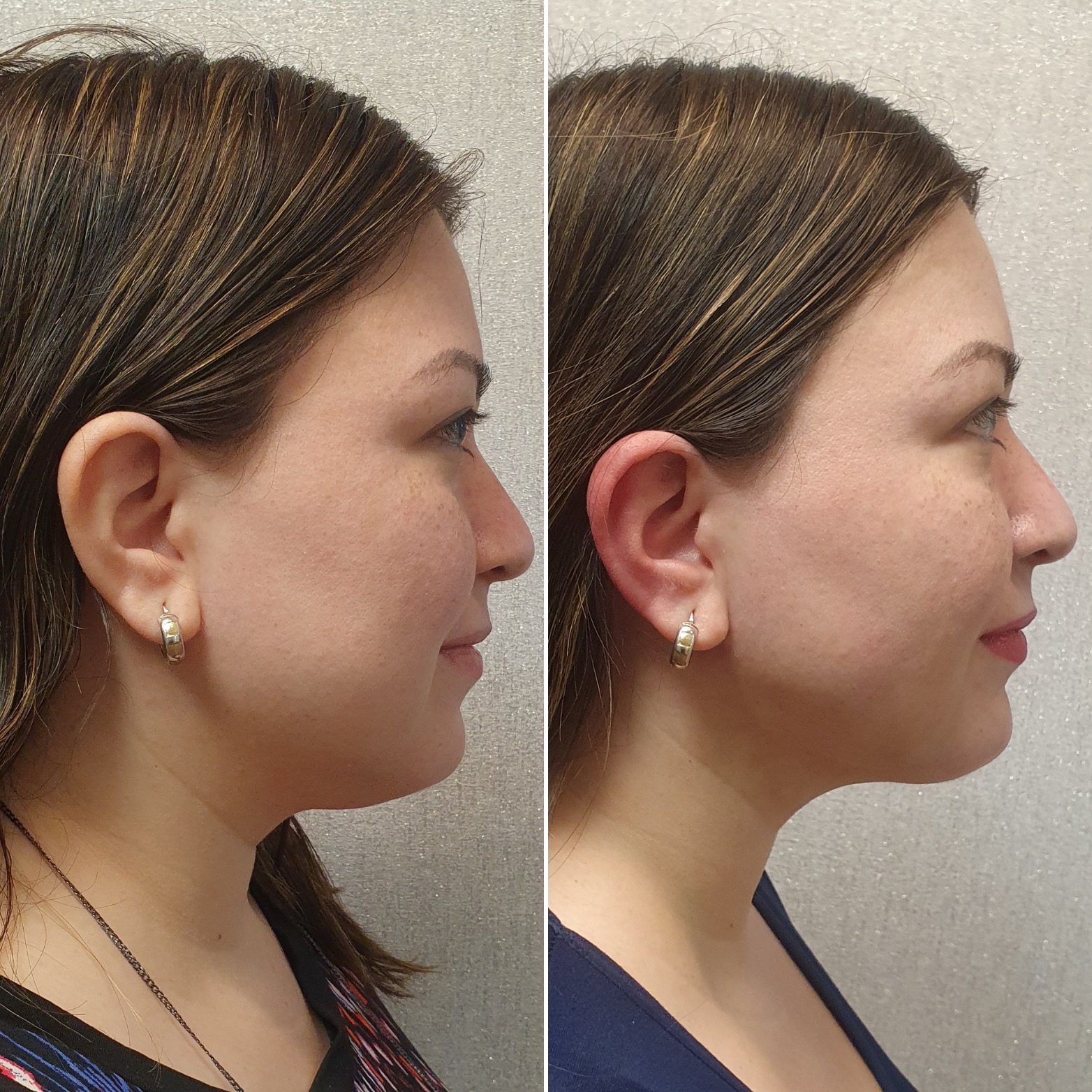 Antes y después · Liposucción Cervical · Perfil · definición cervical