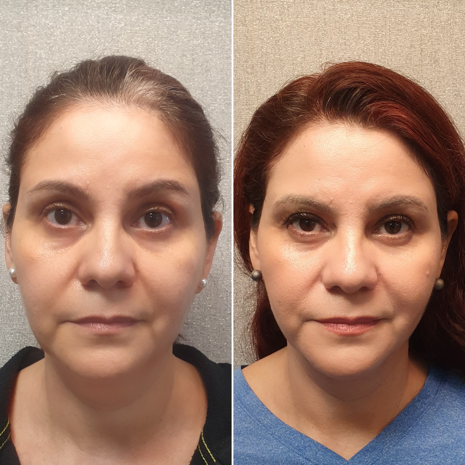 Antes y después · Liposucción Cervical · Frontal · definición del tercio inferior