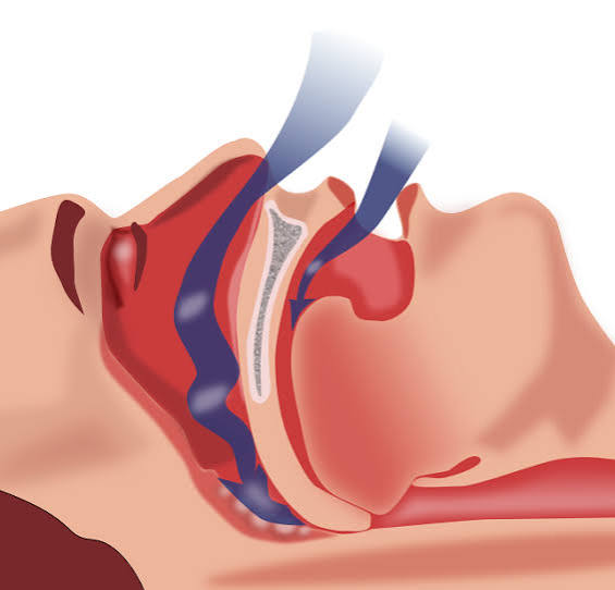 Apnea del Sueño