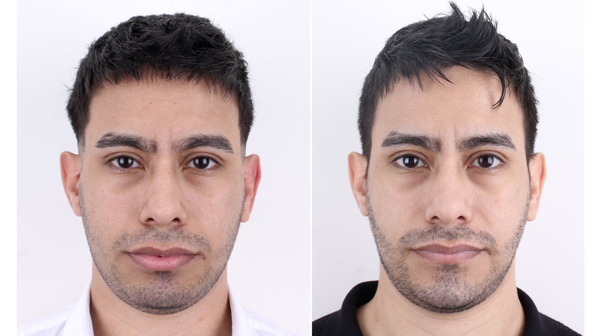 Antes y después · Liposucción Cervical · Vista frontal antes y después: armonía del tercio inferior tras mentoplastia y liposucción cervical.