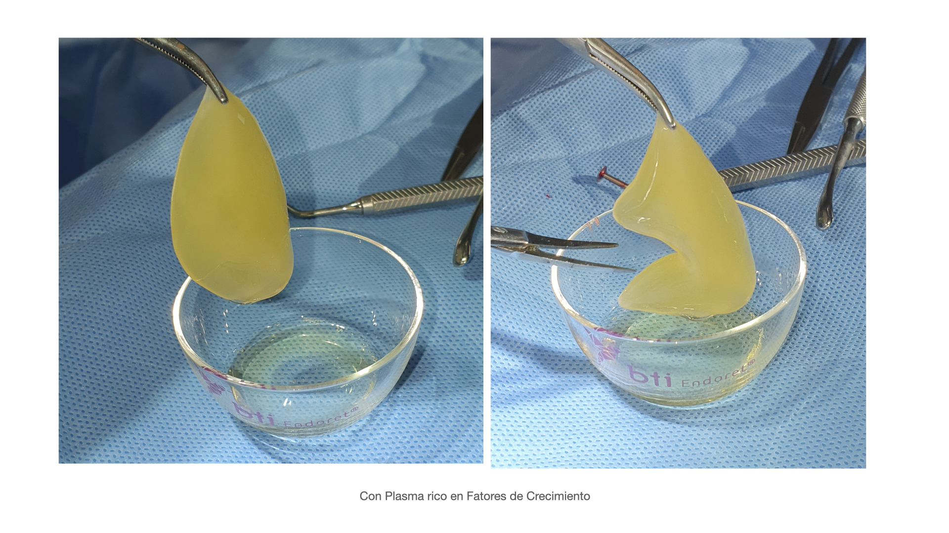 Plasma Rico en Factores de Crecimiento
