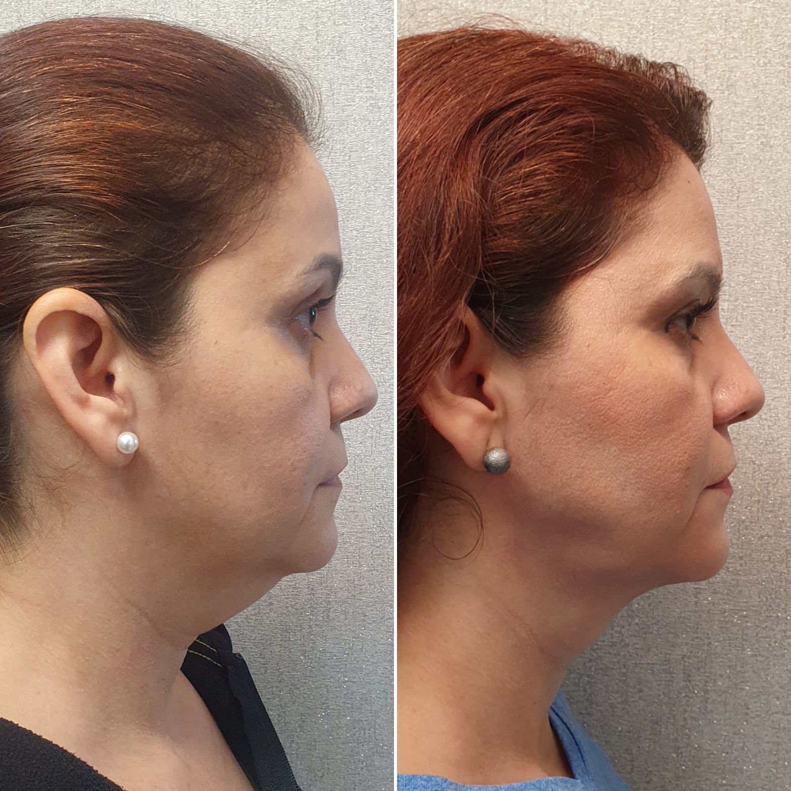 Antes y después · Liposucción Cervical · Perfil · definición del cuello