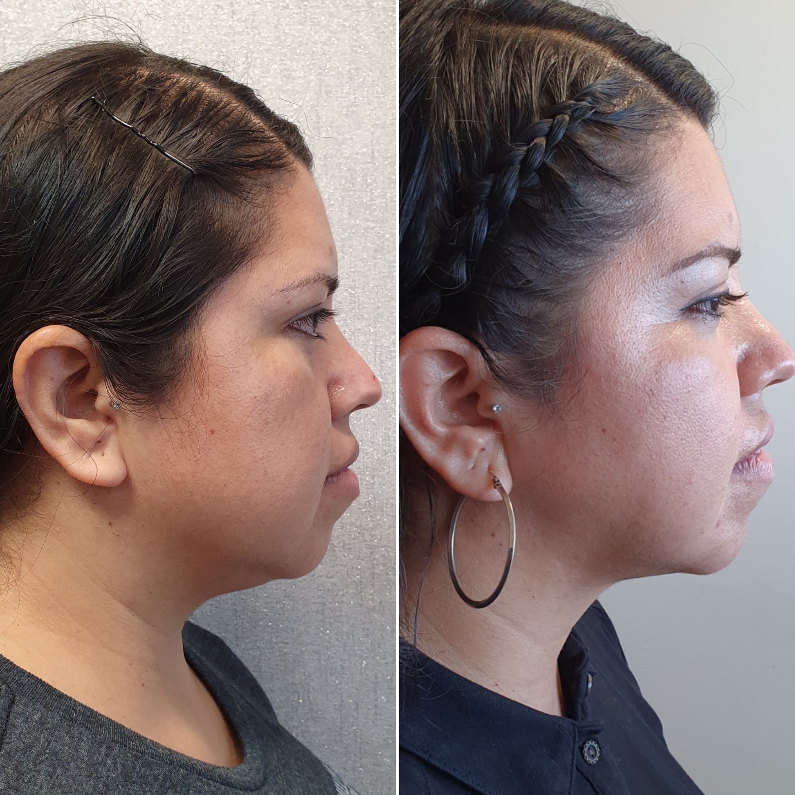 Antes y después · Liposucción Cervical · Perfil · contorno cervicomandibular