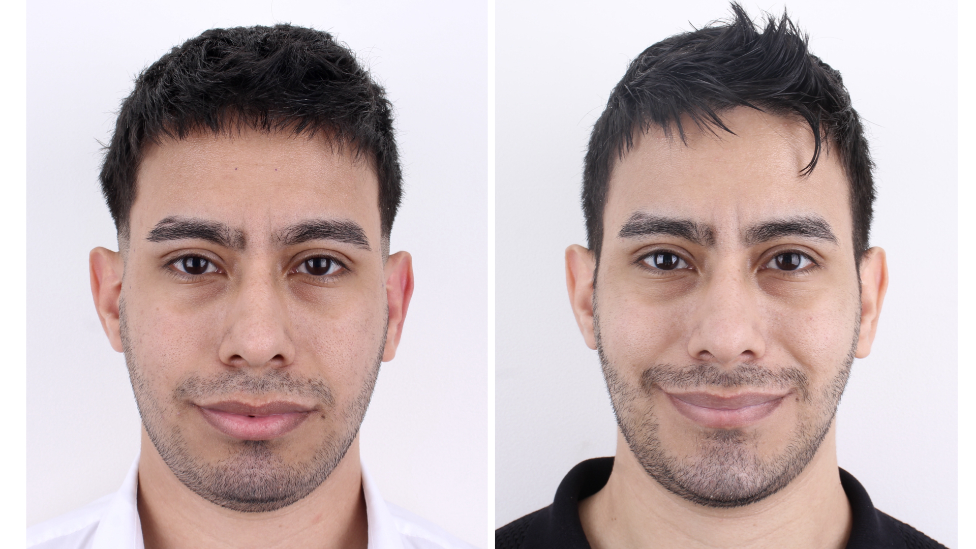 Antes y después · Liposucción Cervical · Frontal sonriendo antes y después: equilibrio del mentón y contorno facial.