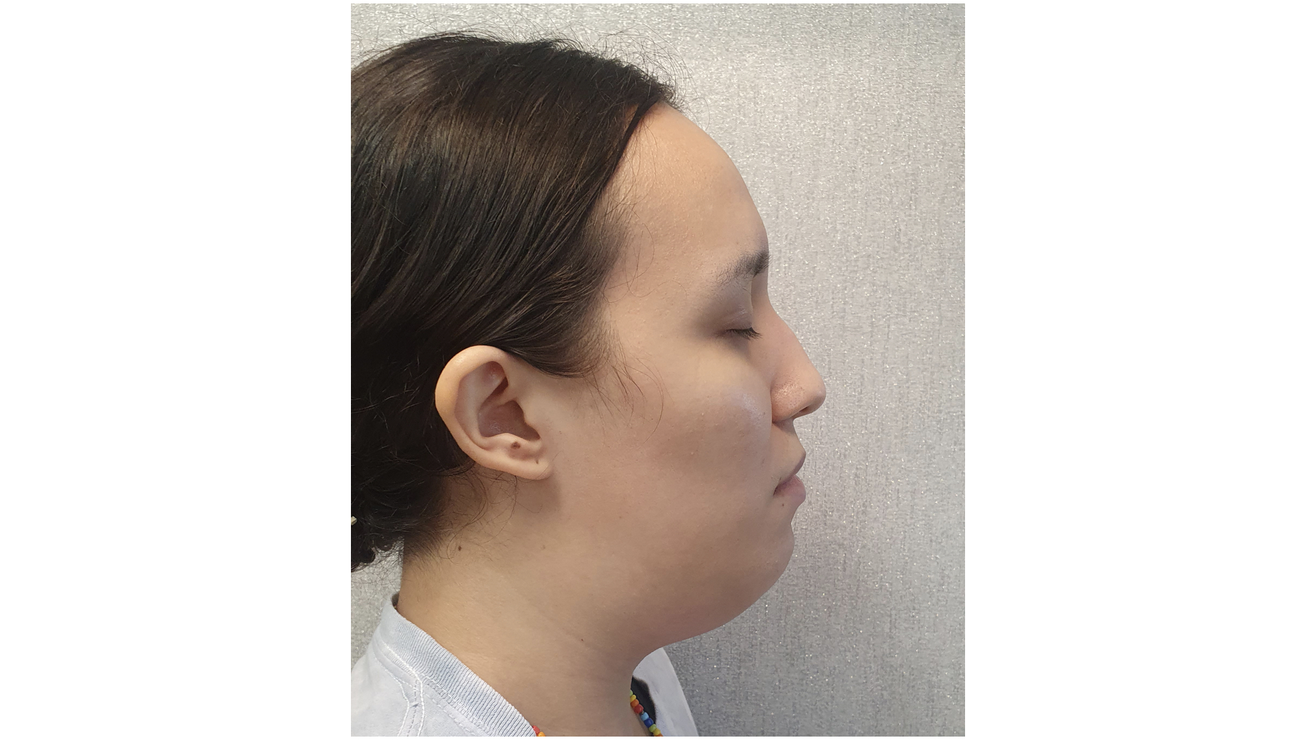 Infecciones y Abscesos Dentales y Faciales