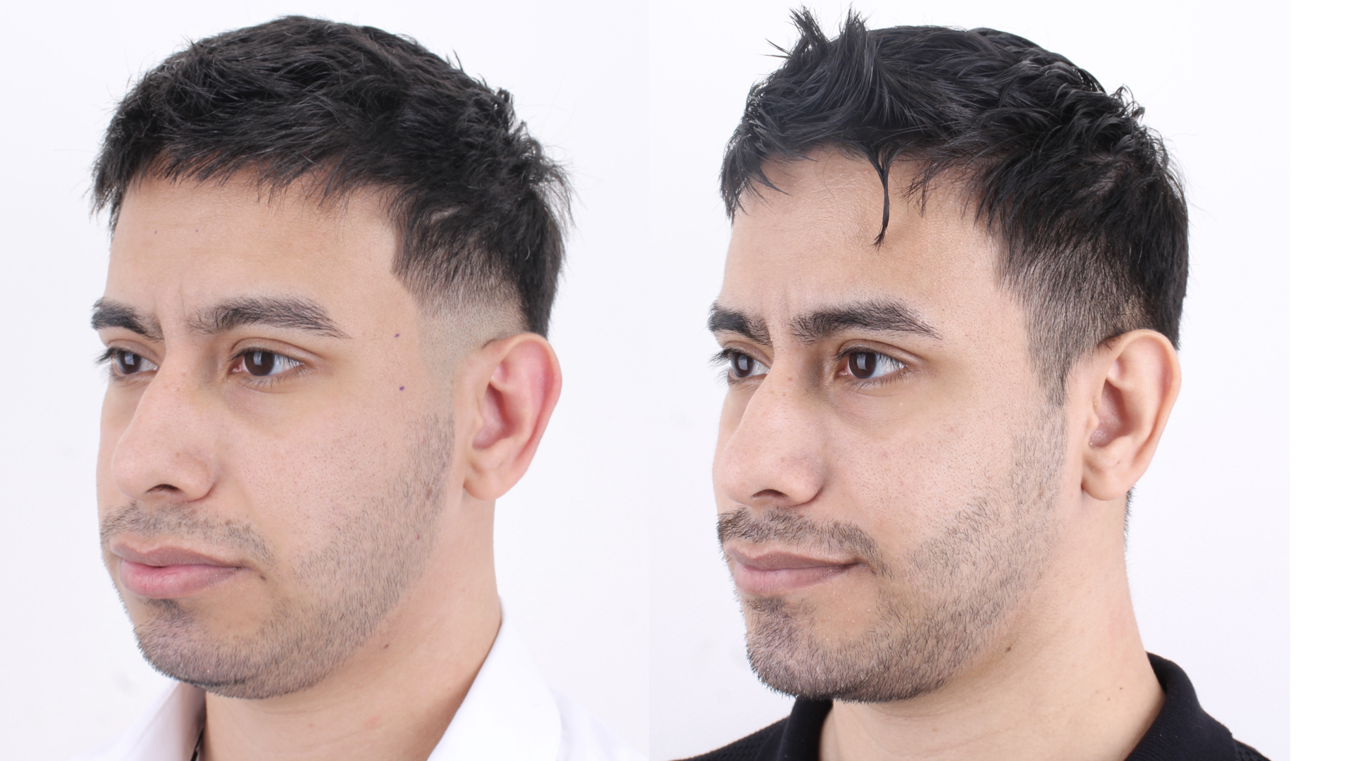 Antes y después · Liposucción Cervical · Tres cuartos de acercamiento antes y después: contorno mandibular más marcado.