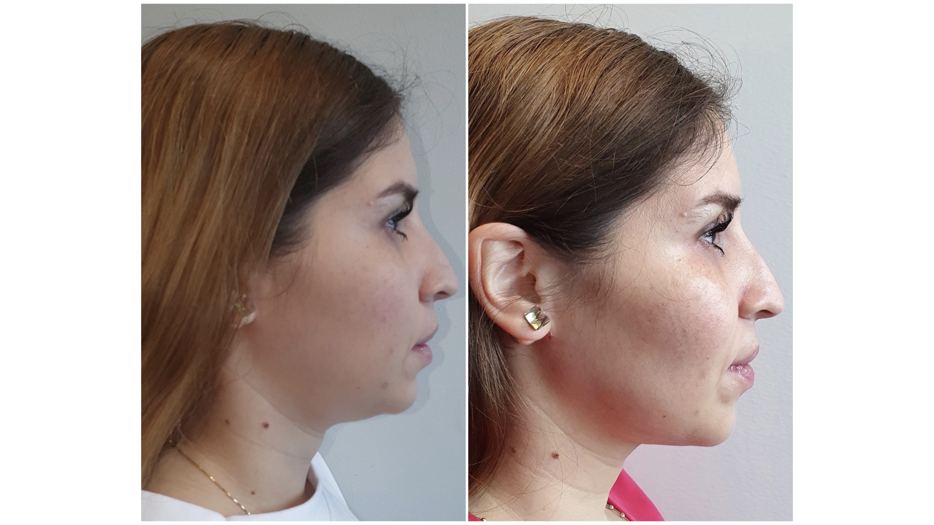 Antes y después · Liposucción Cervical · Perfil · perfil juvenil definido