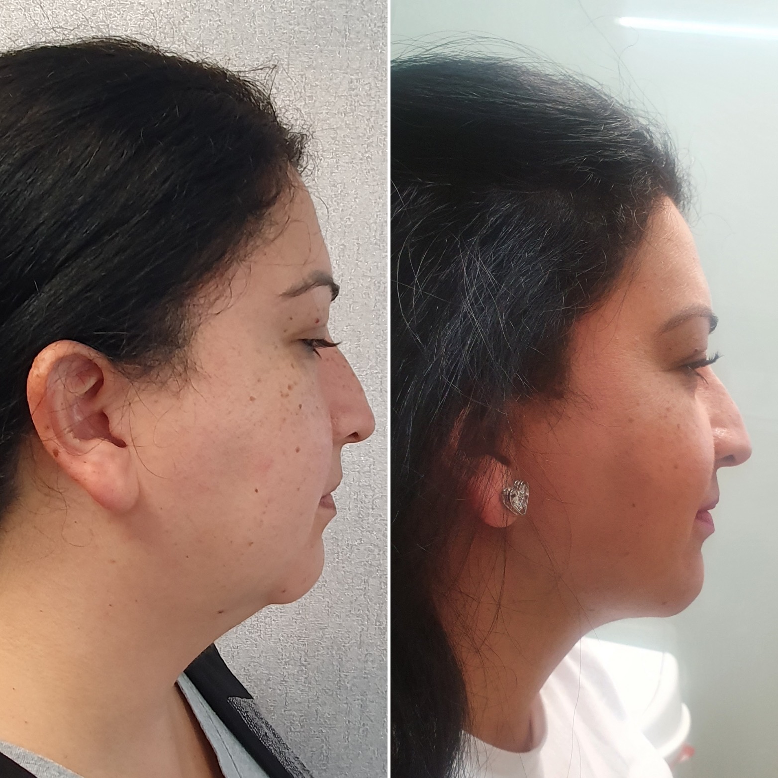 Antes y después · Liposucción Cervical · Perfil · definición del ángulo cervicomandibular