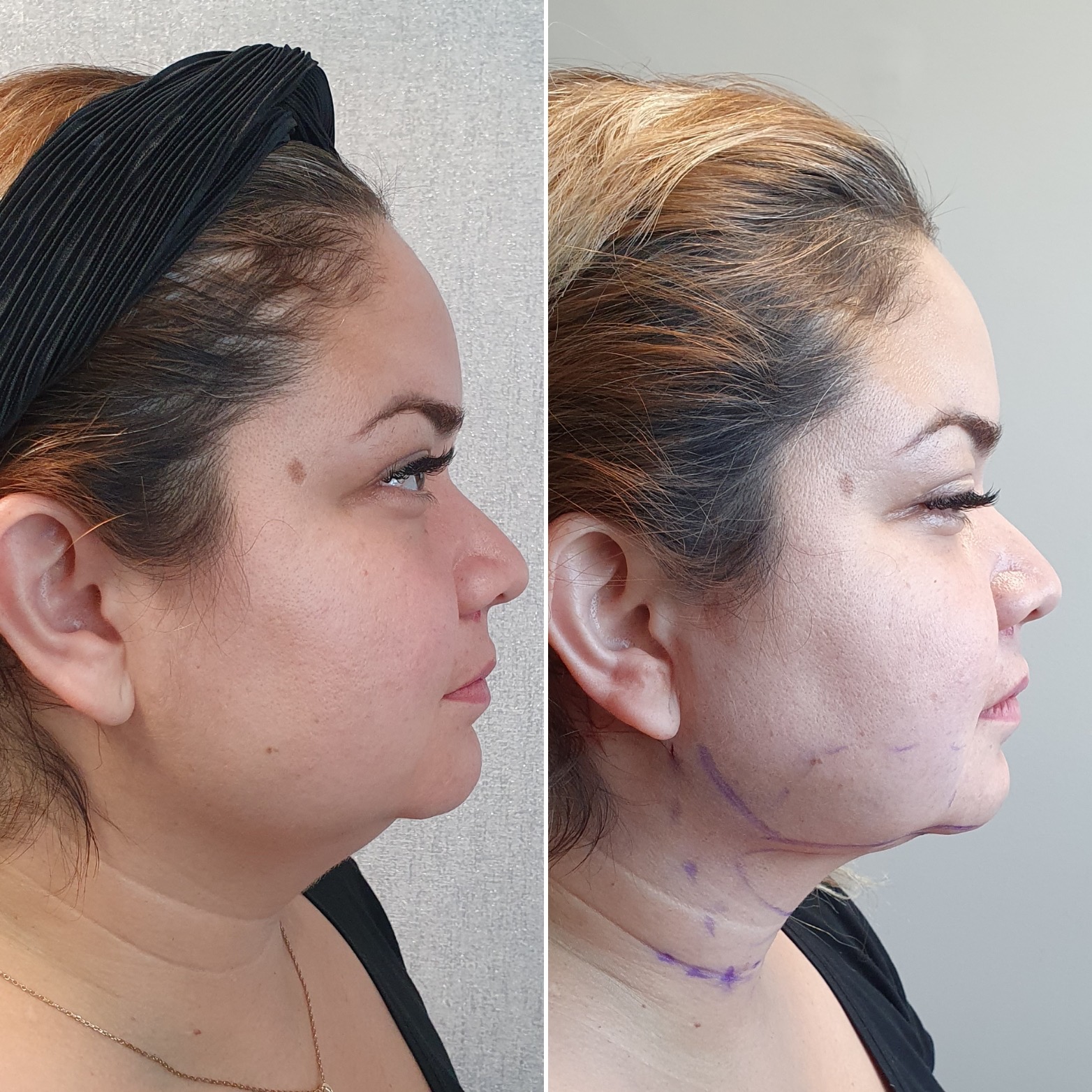 Antes y después · Liposucción Cervical · Perfil · marcaje preoperatorio y contorno