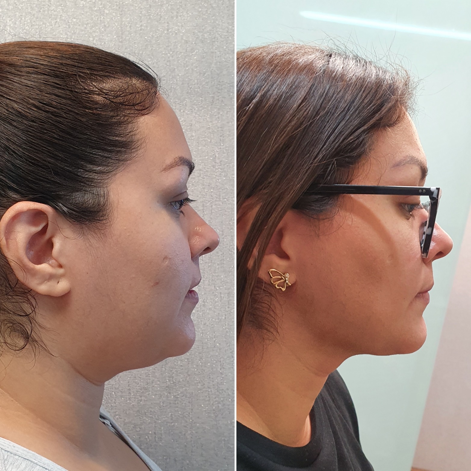 Antes y después · Liposucción Cervical · Perfil · contorno submandibular