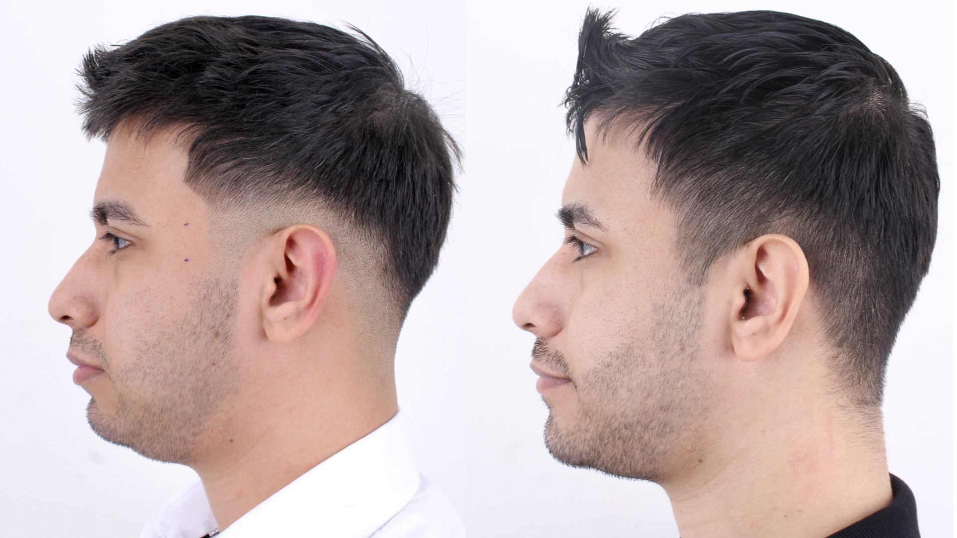 Antes y después · Liposucción Cervical · Perfil de acercamiento antes y después: mayor proyección mentoniana y cuello definido.