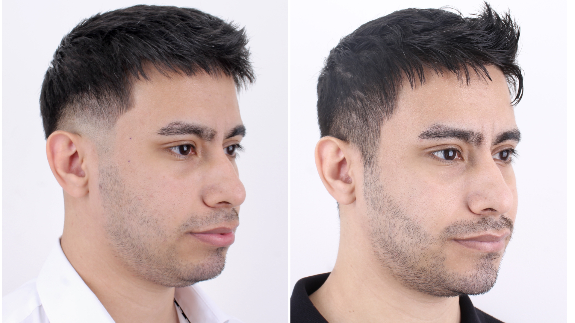 Antes y después · Liposucción Cervical · Tres cuartos antes y después: definición de la línea mandibular.