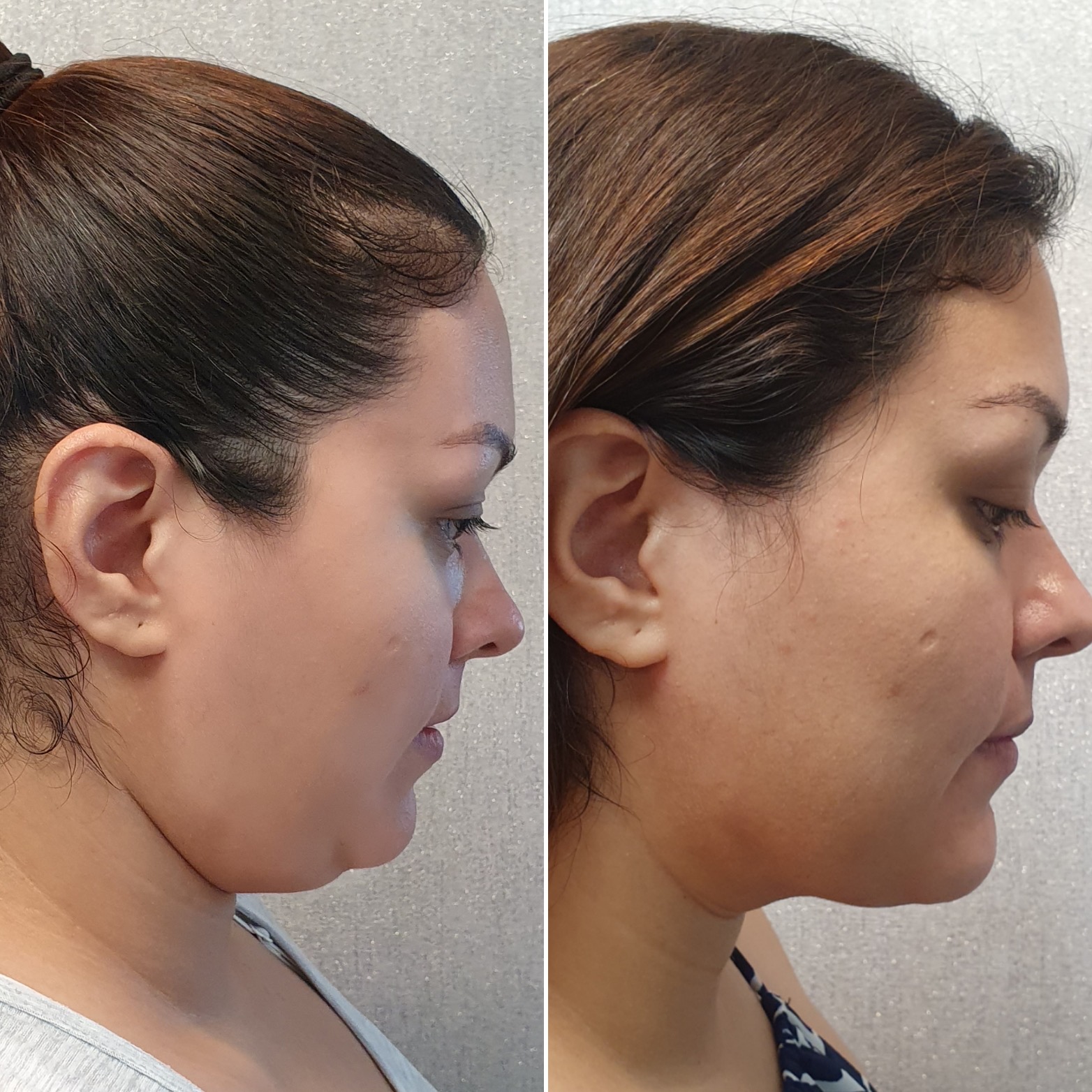 Antes y después · Liposucción Cervical · Perfil · perfilado de la línea mandibular