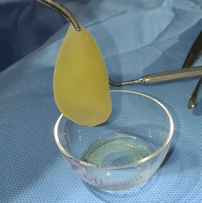 Plasma Rico en Factores de Crecimiento