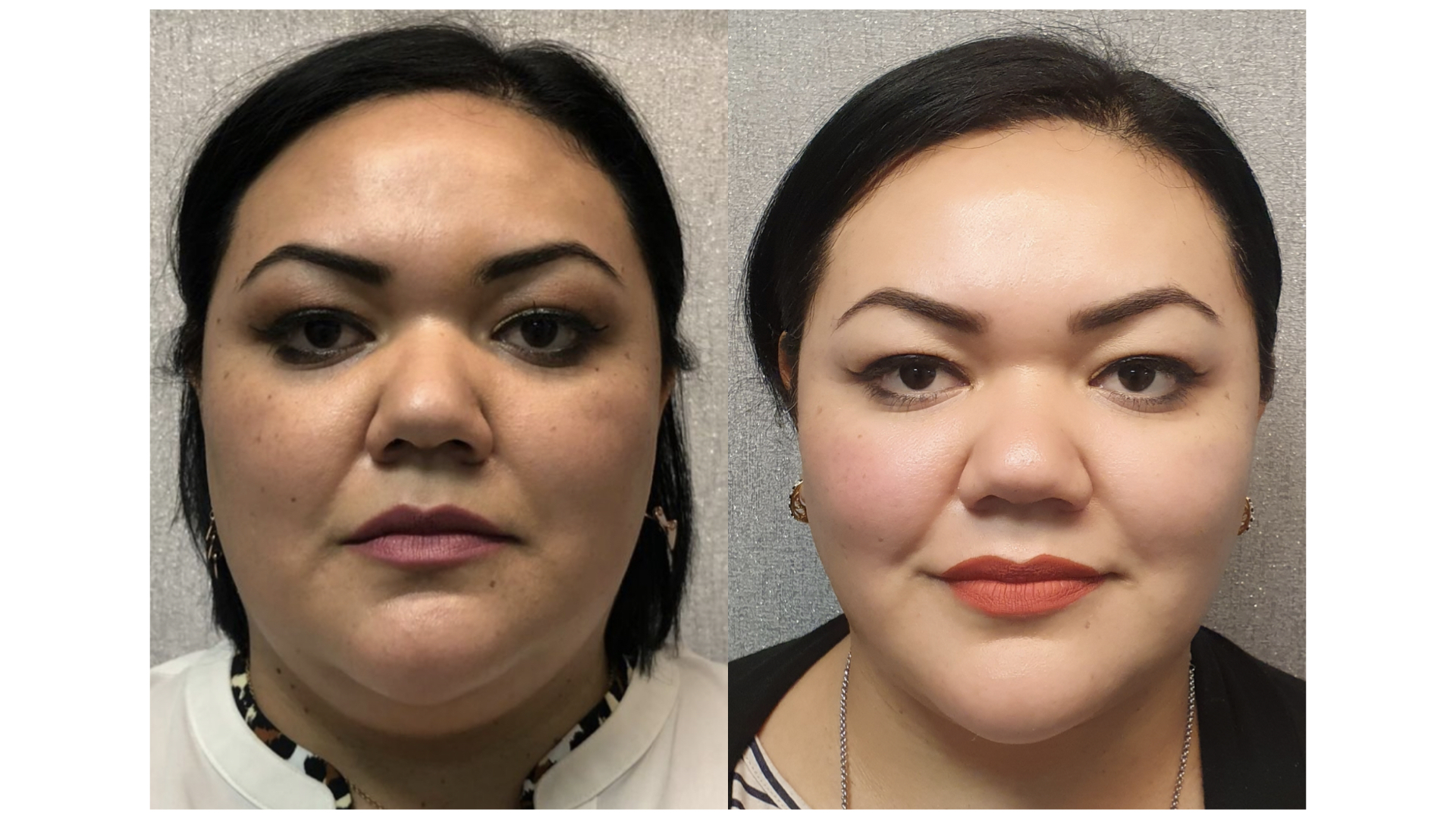 Antes y después · Liposucción Cervical · Frontal · redefinición facial