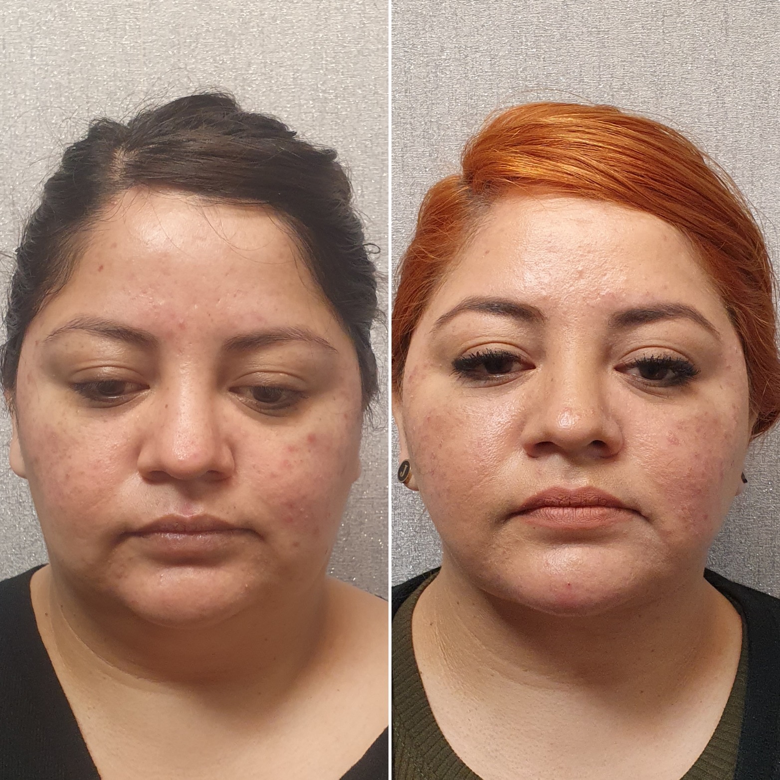 Antes y después · Liposucción Cervical · Frontal · afinamiento del contorno facial