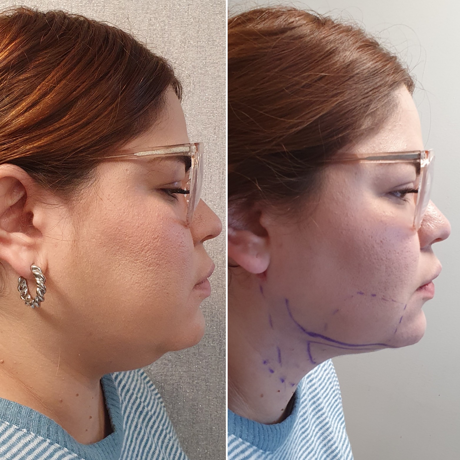 Antes y después · Liposucción Cervical · Perfil · marcaje quirúrgico y resultado