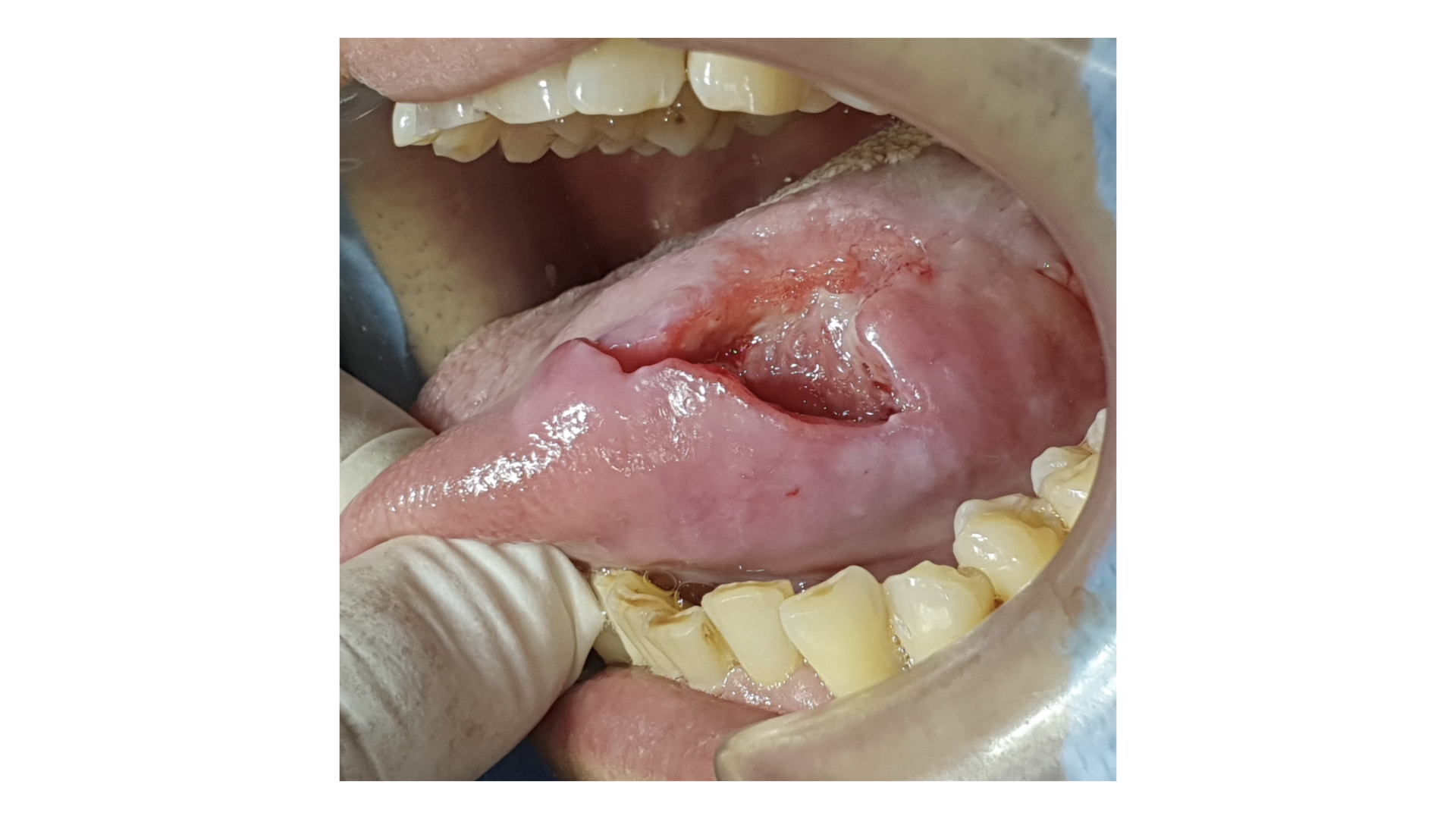 Cáncer Oral