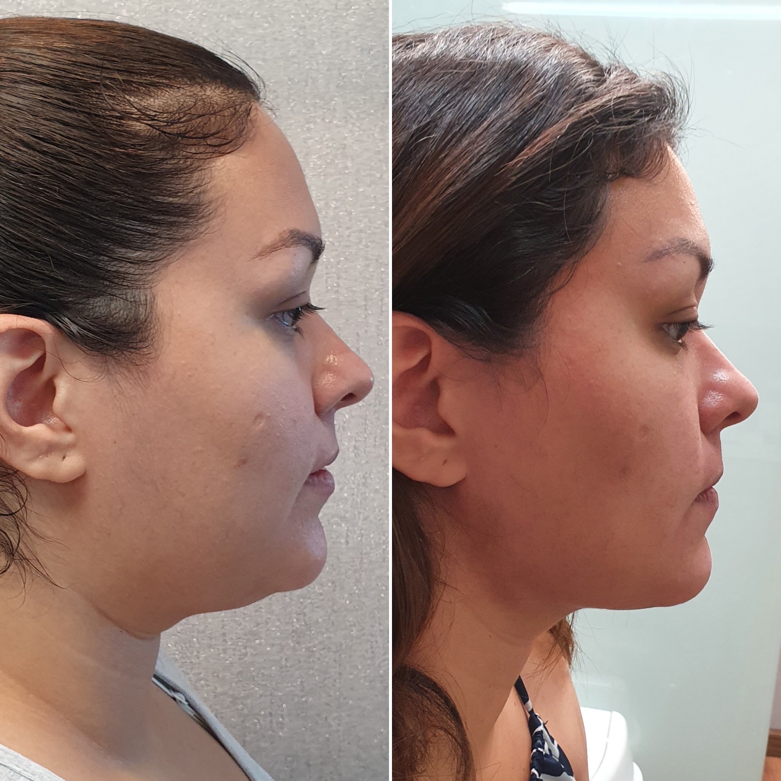 Antes y después · Liposucción Cervical · Perfil · afinamiento submentoniano