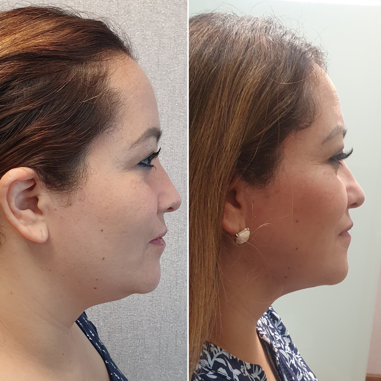 Antes y después · Liposucción Cervical · Perfil · ángulo cervicomandibular definido