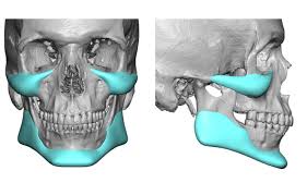 Implantes Faciales