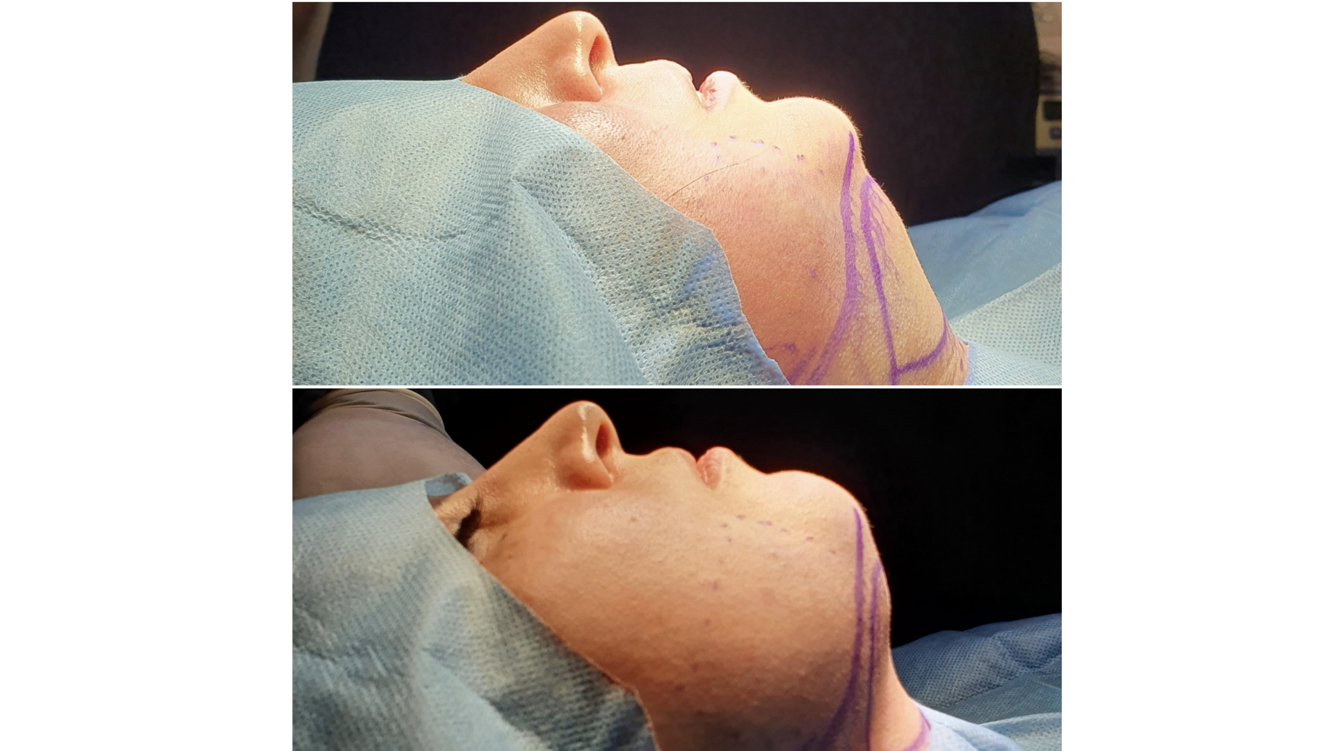 Antes y después · Liposucción Cervical · Transquirúrgico · marcaje y resultado inmediato