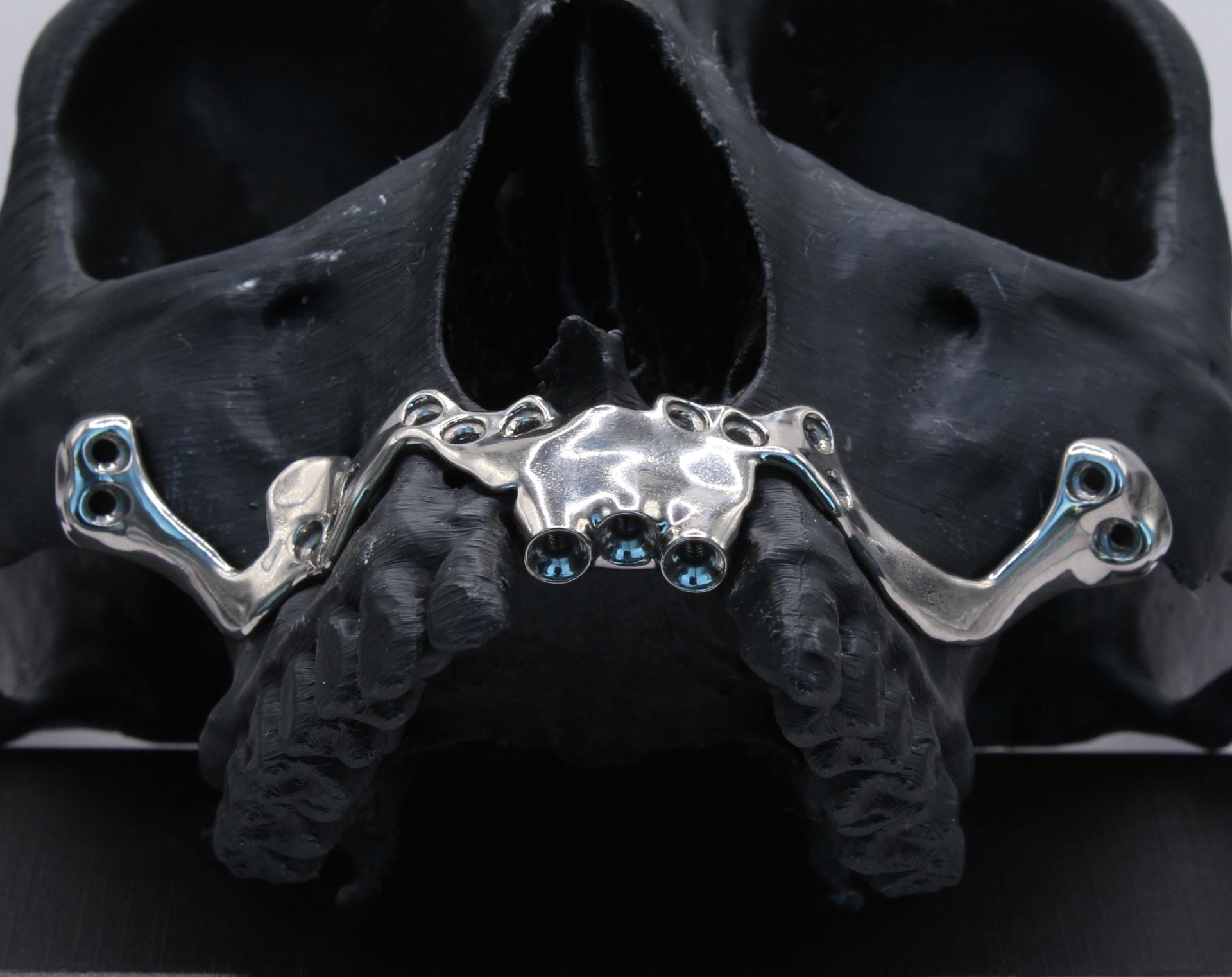 Implantes Subperiósticos Personalizados