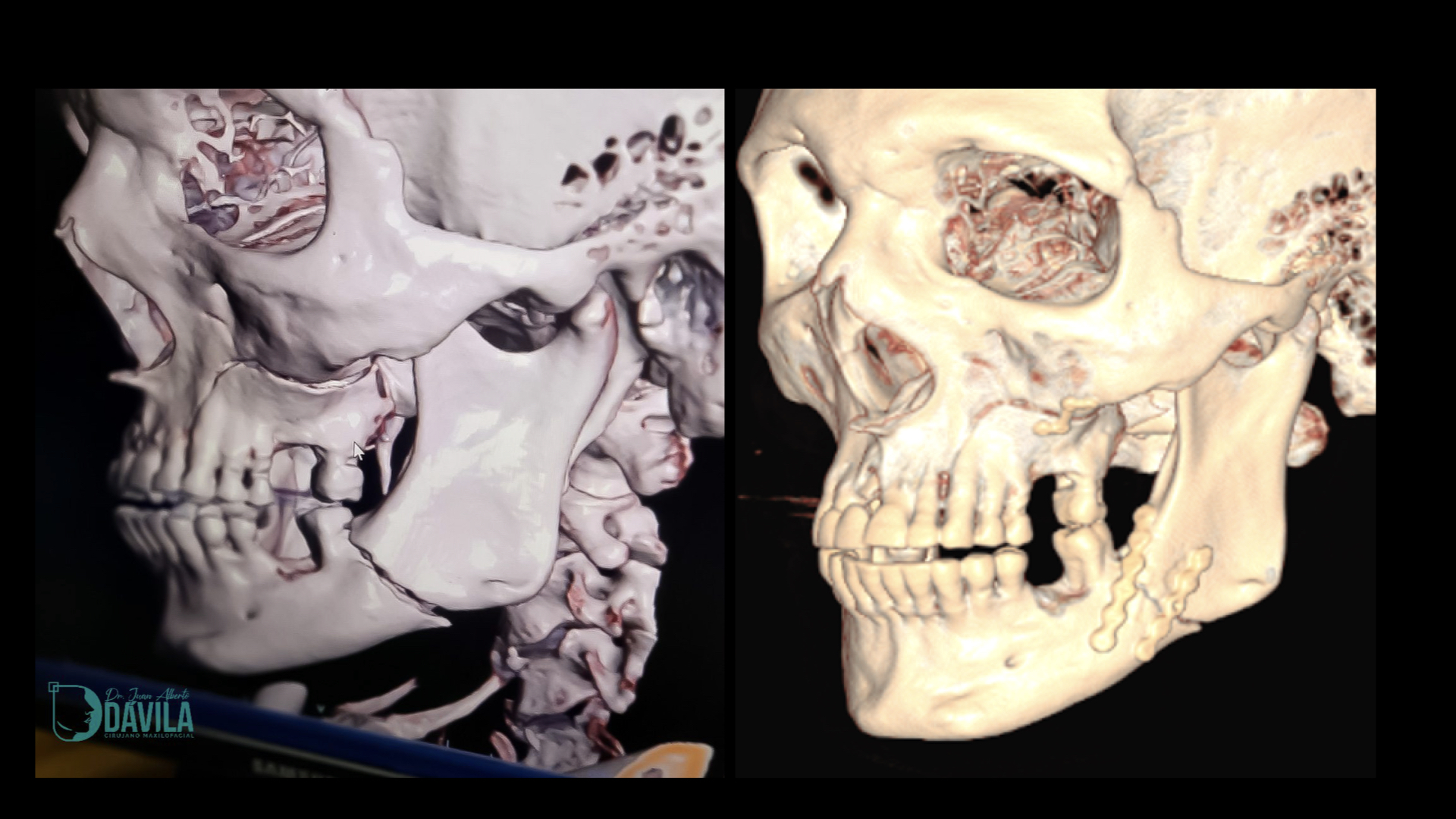 Traumatismos y Fracturas Faciales