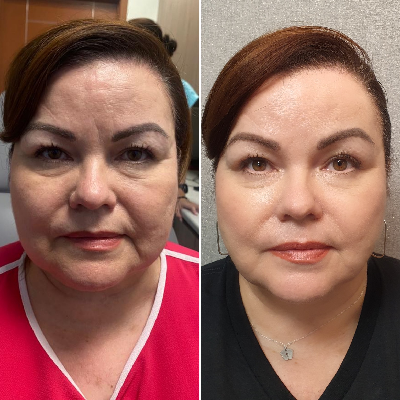 Antes y después · Liposucción Cervical · Frontal · rejuvenecimiento del contorno
