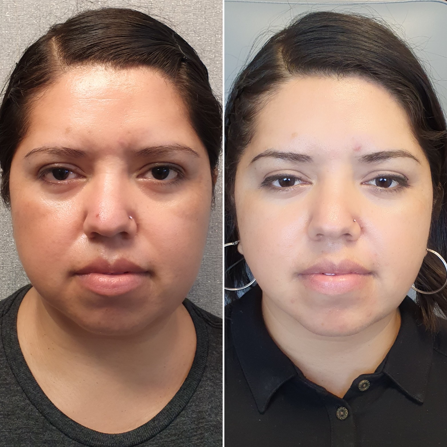 Antes y después · Liposucción Cervical · Frontal · afinamiento del tercio inferior