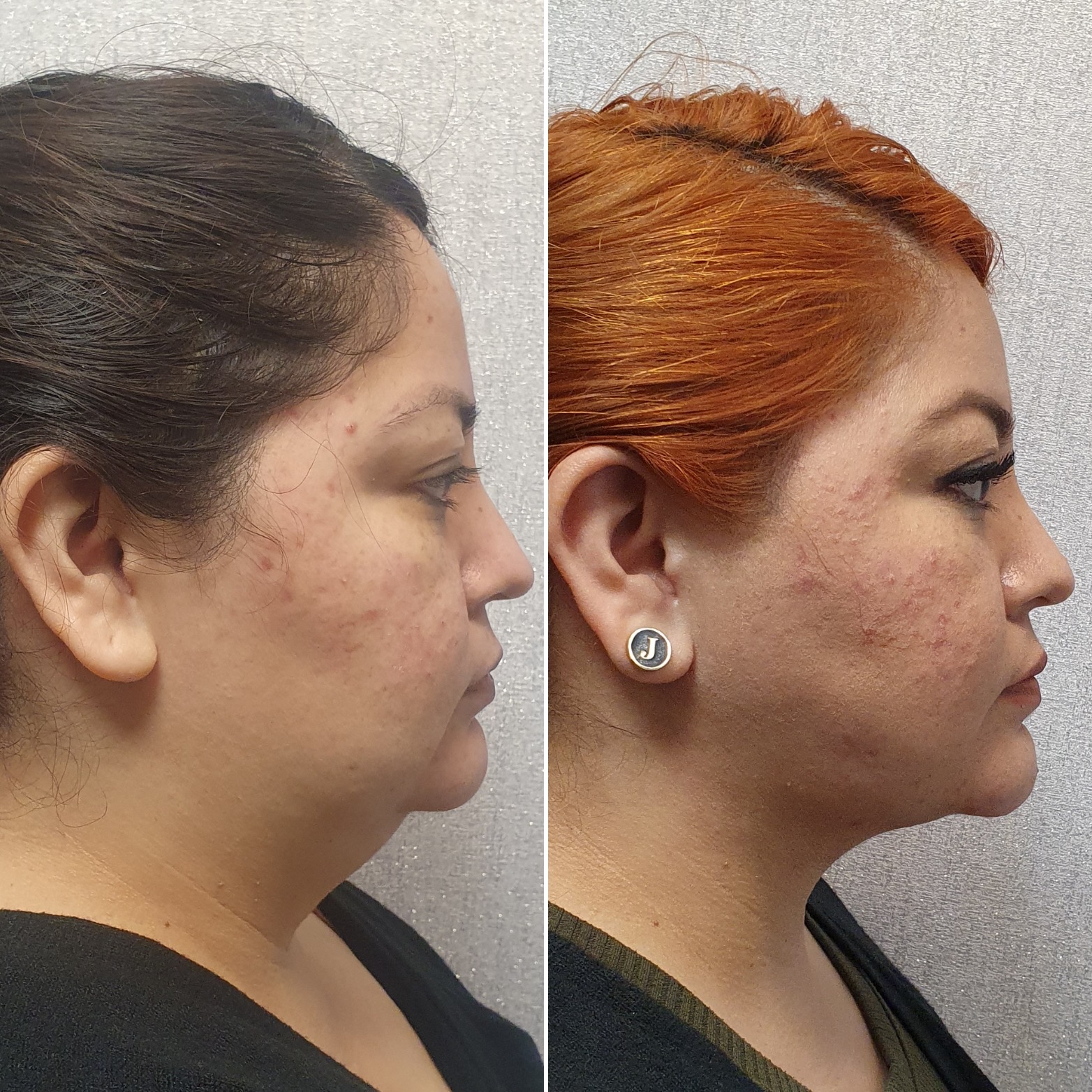 Antes y después · Liposucción Cervical · Perfil · proyección del mentón y cuello