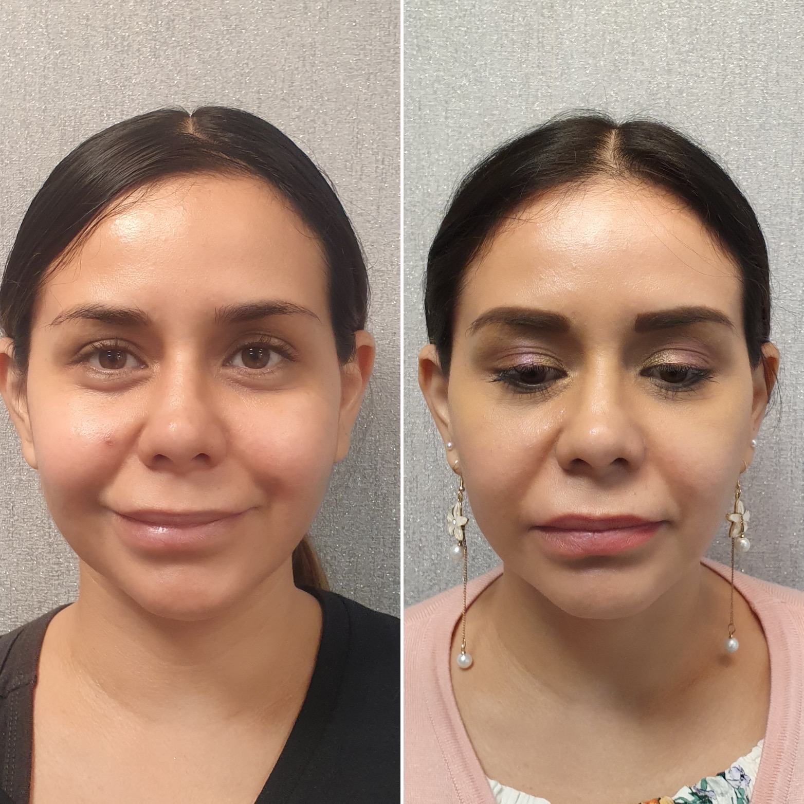Antes y después · Liposucción Cervical · Frontal · resultado a los meses