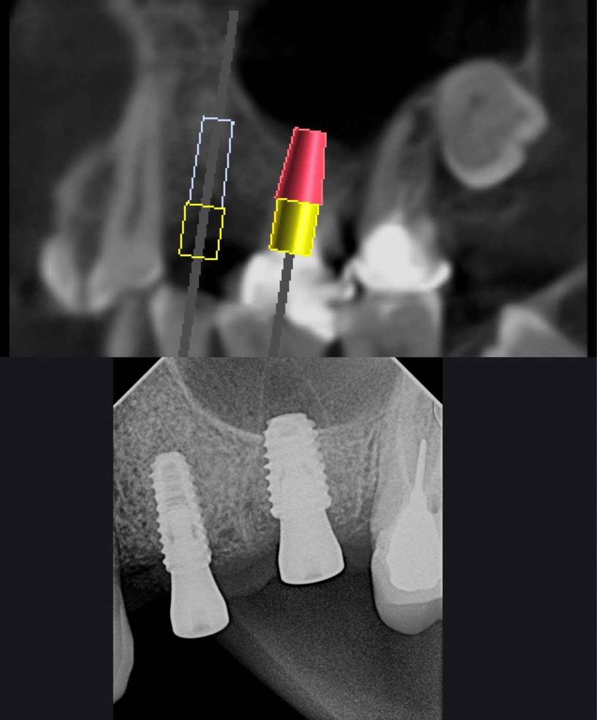 Implantes Dentales