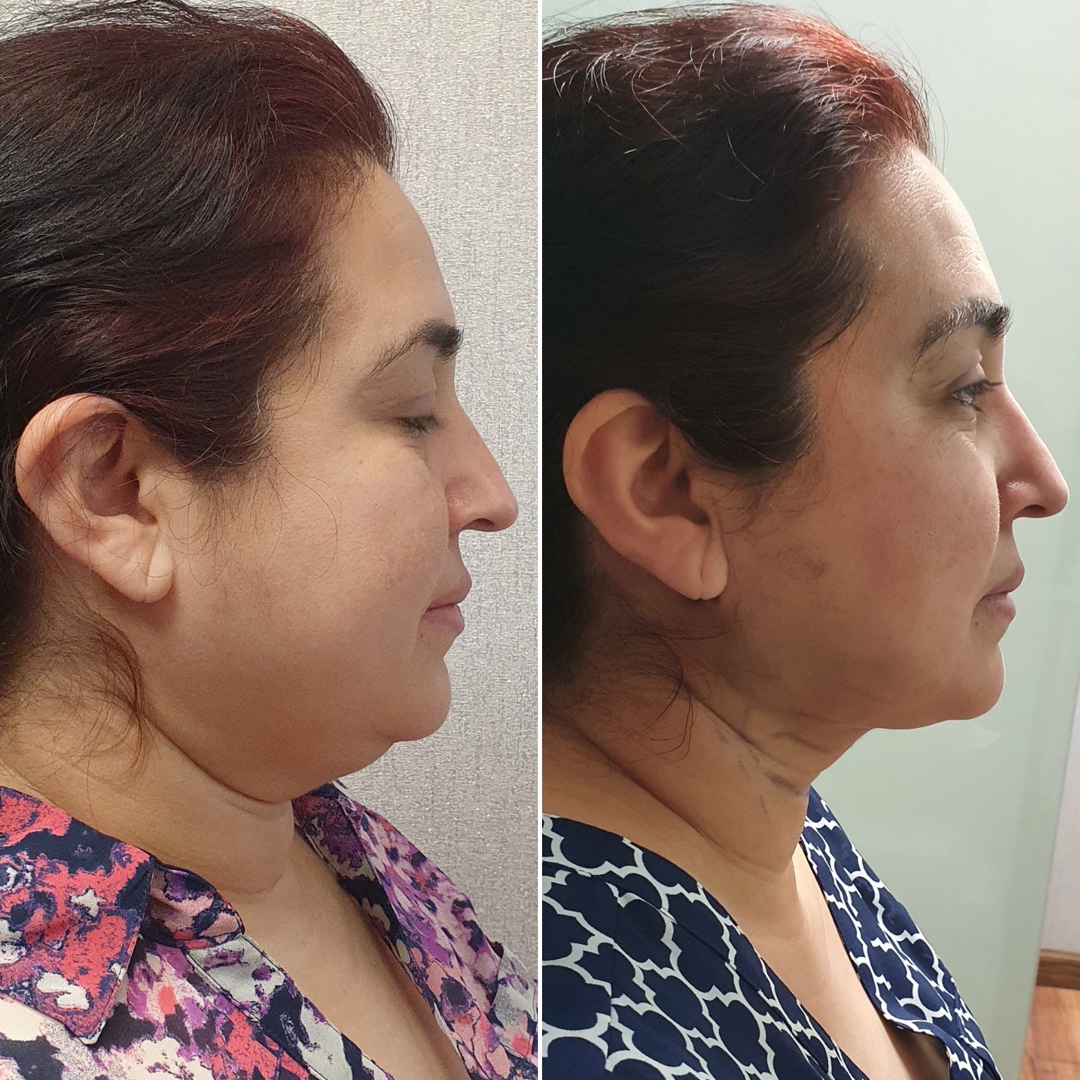 Antes y después · Liposucción Cervical · Perfil · reducción de grasa submentoniana