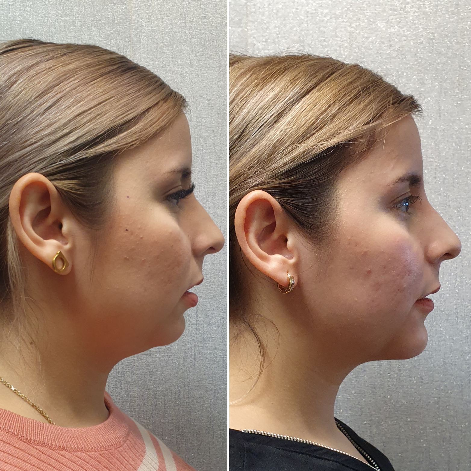 Mentoplastia