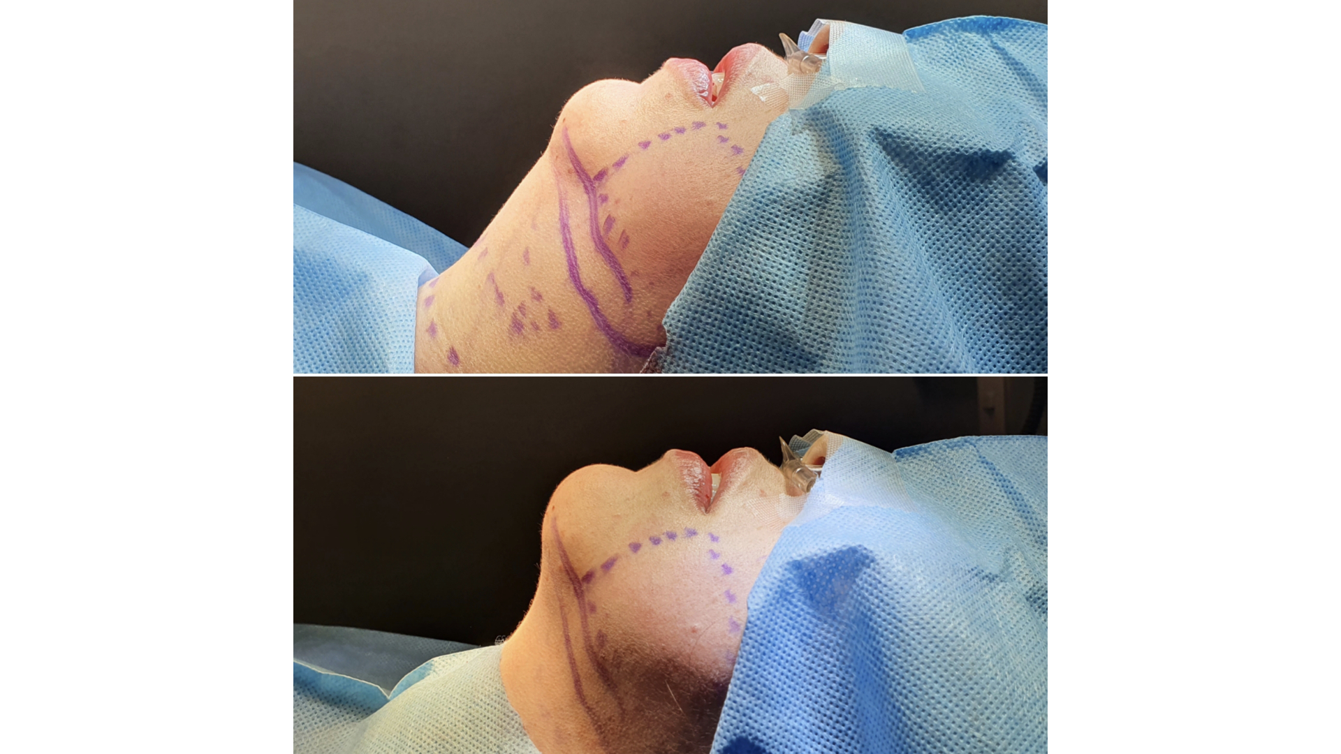Antes y después · Liposucción Cervical · Transquirúrgico · planeación de la lipoescultura