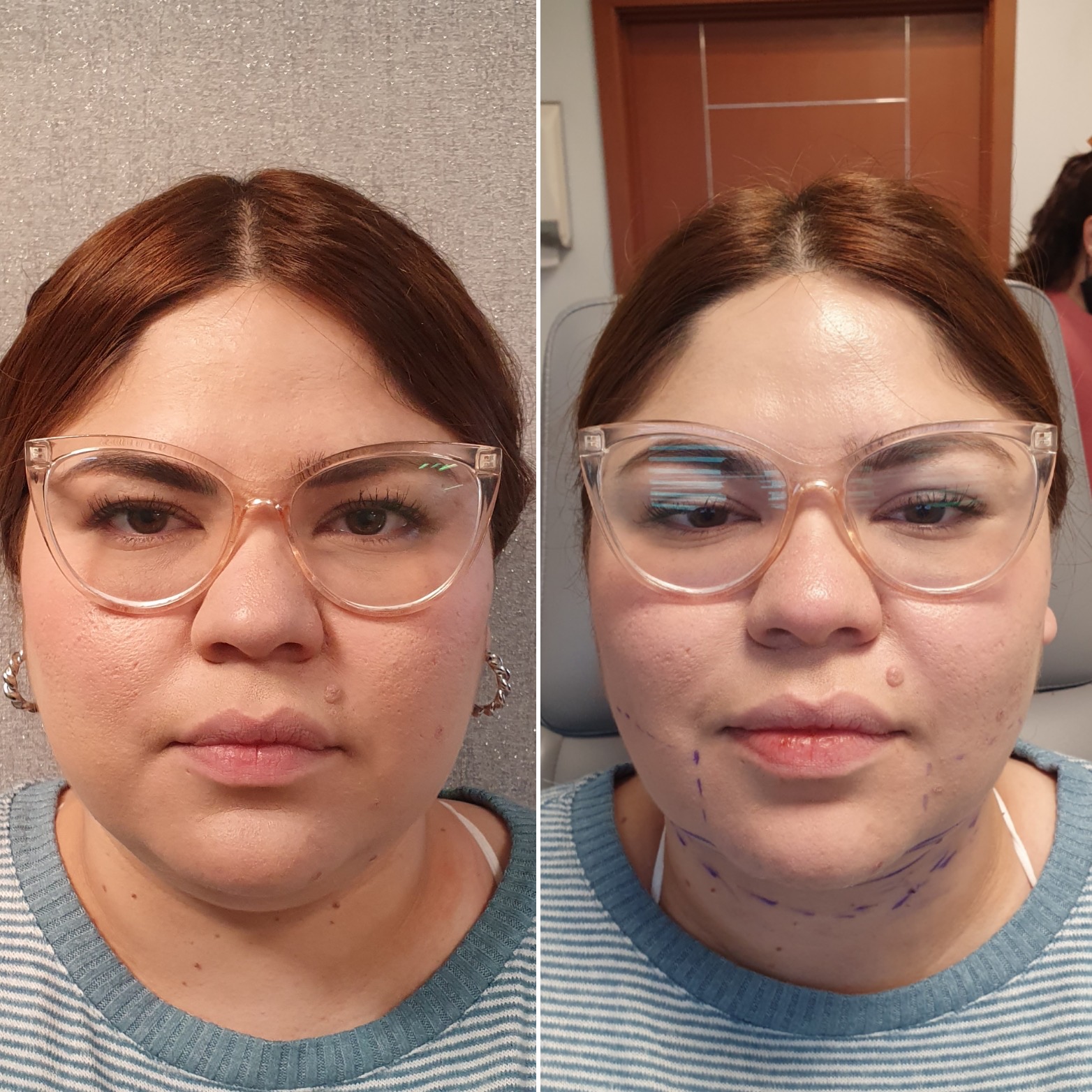 Antes y después · Liposucción Cervical · Frontal · armonía del tercio inferior