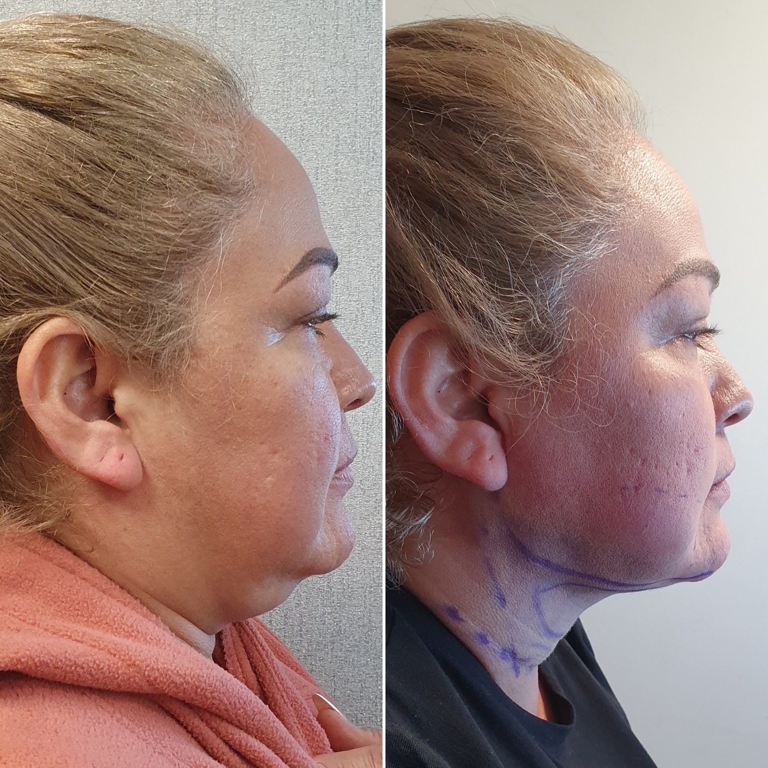 Antes y después · Liposucción Cervical · Perfil · redefinición de la línea mandibular