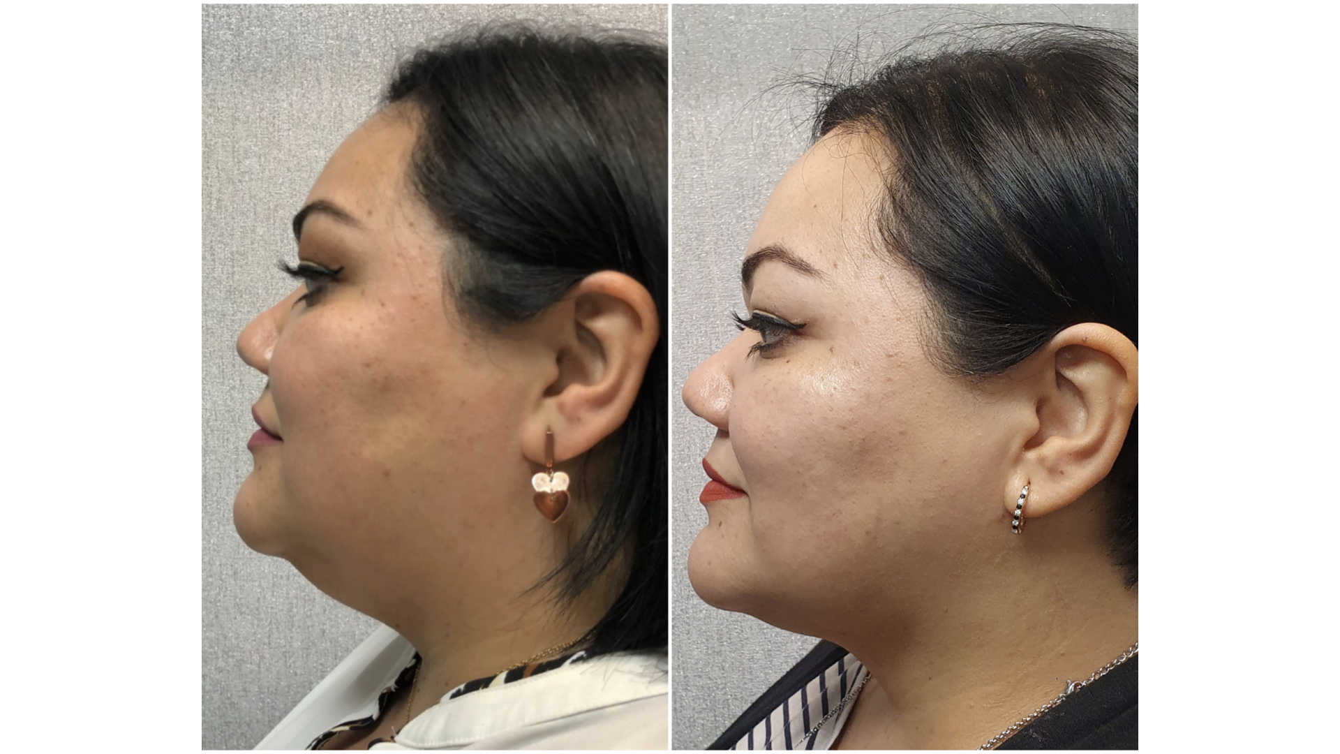 Antes y después · Liposucción Cervical · Perfil · reducción de grasa submentoniana