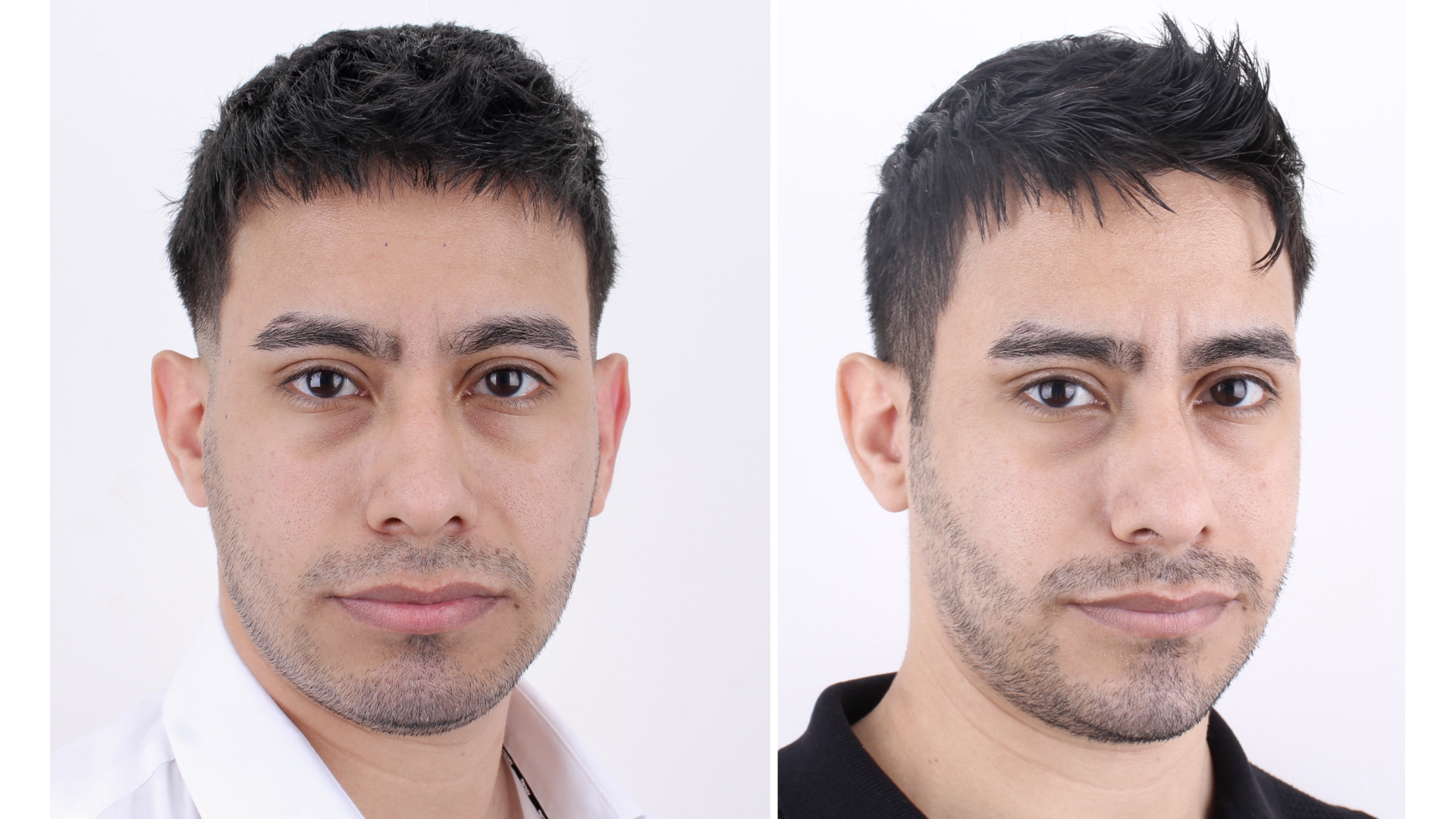 Antes y después · Liposucción Cervical · Frontal de acercamiento antes y después: afinamiento del tercio inferior.