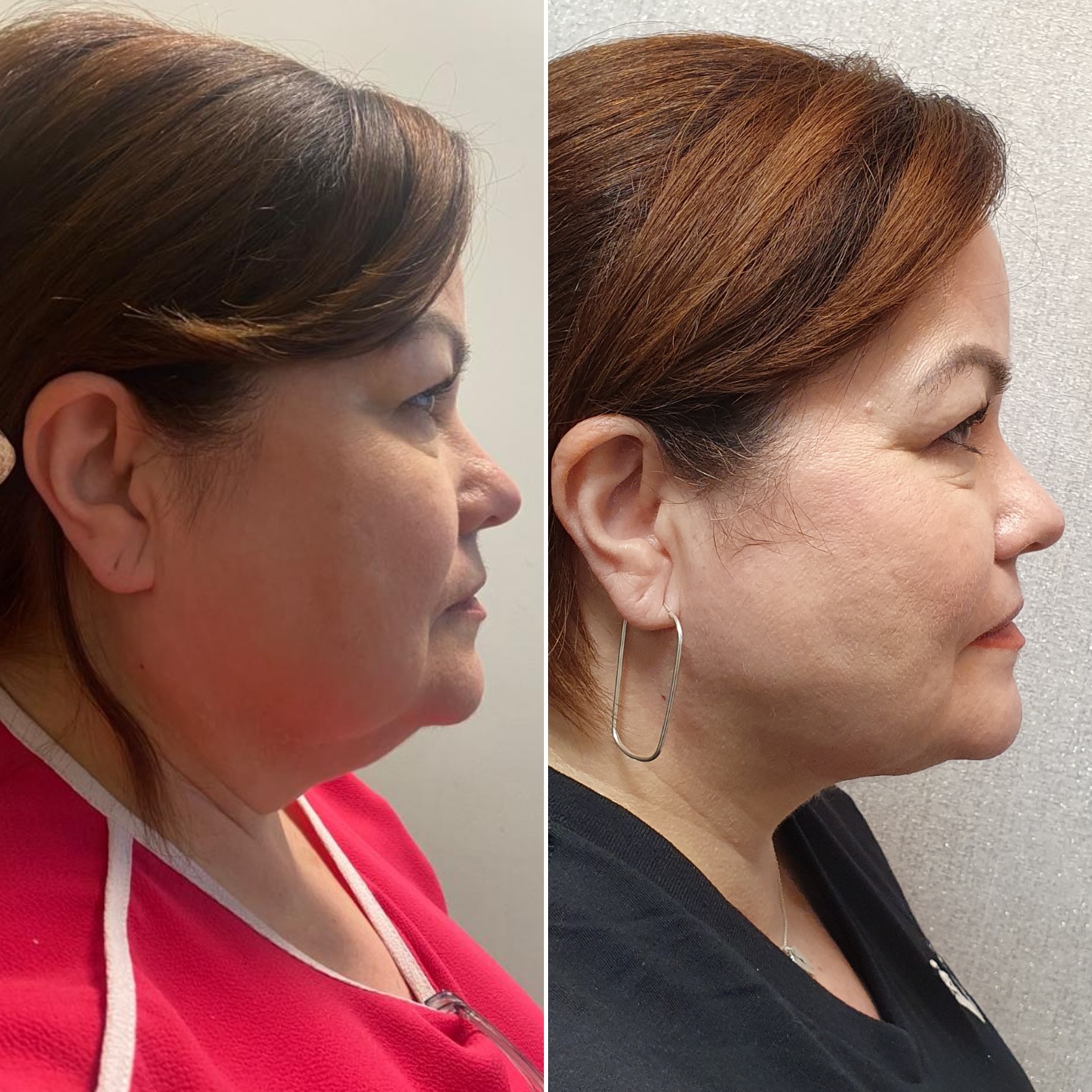 Antes y después · Liposucción Cervical · Perfil · reducción de papada