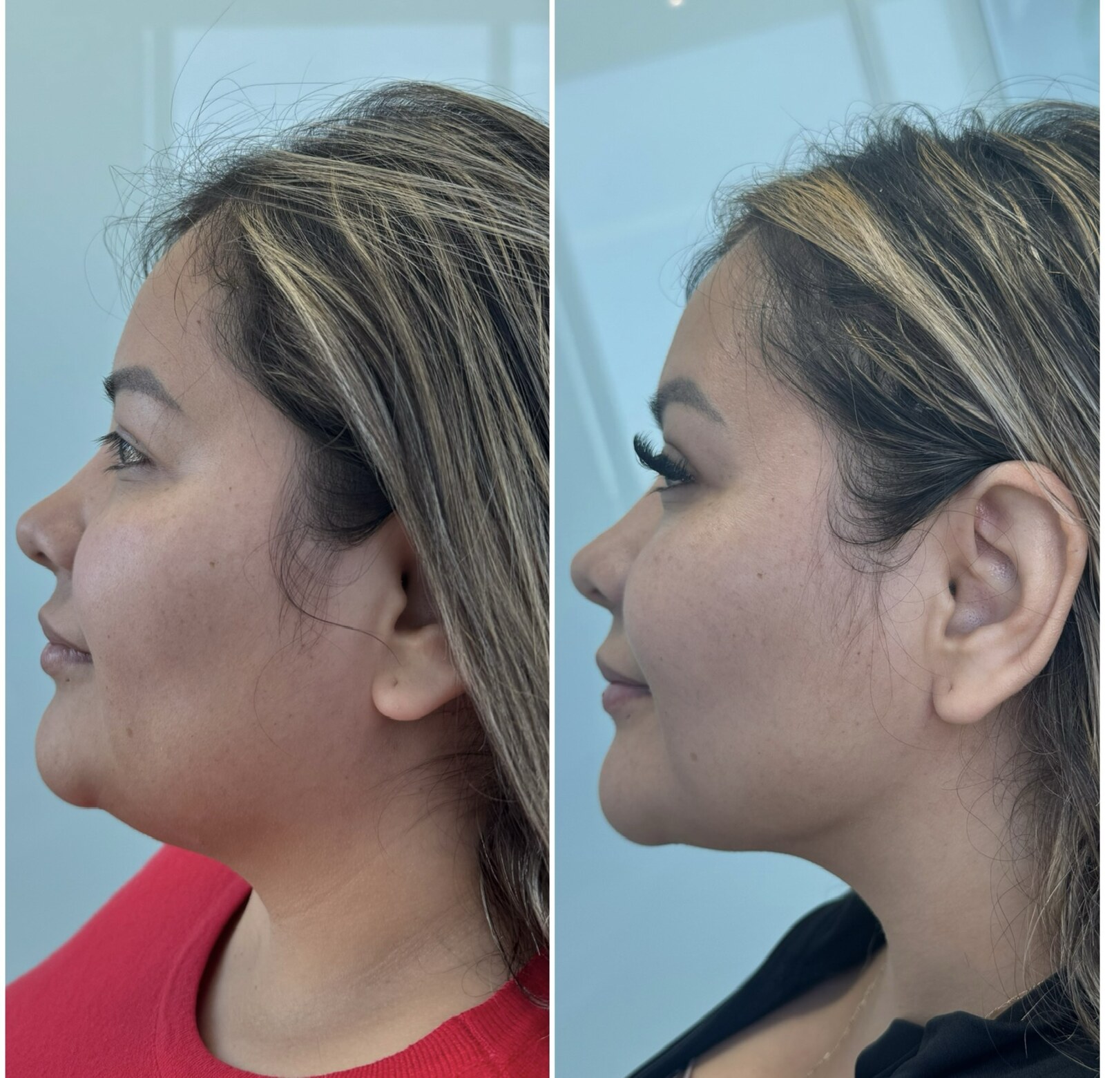 Liposucción Submandibular