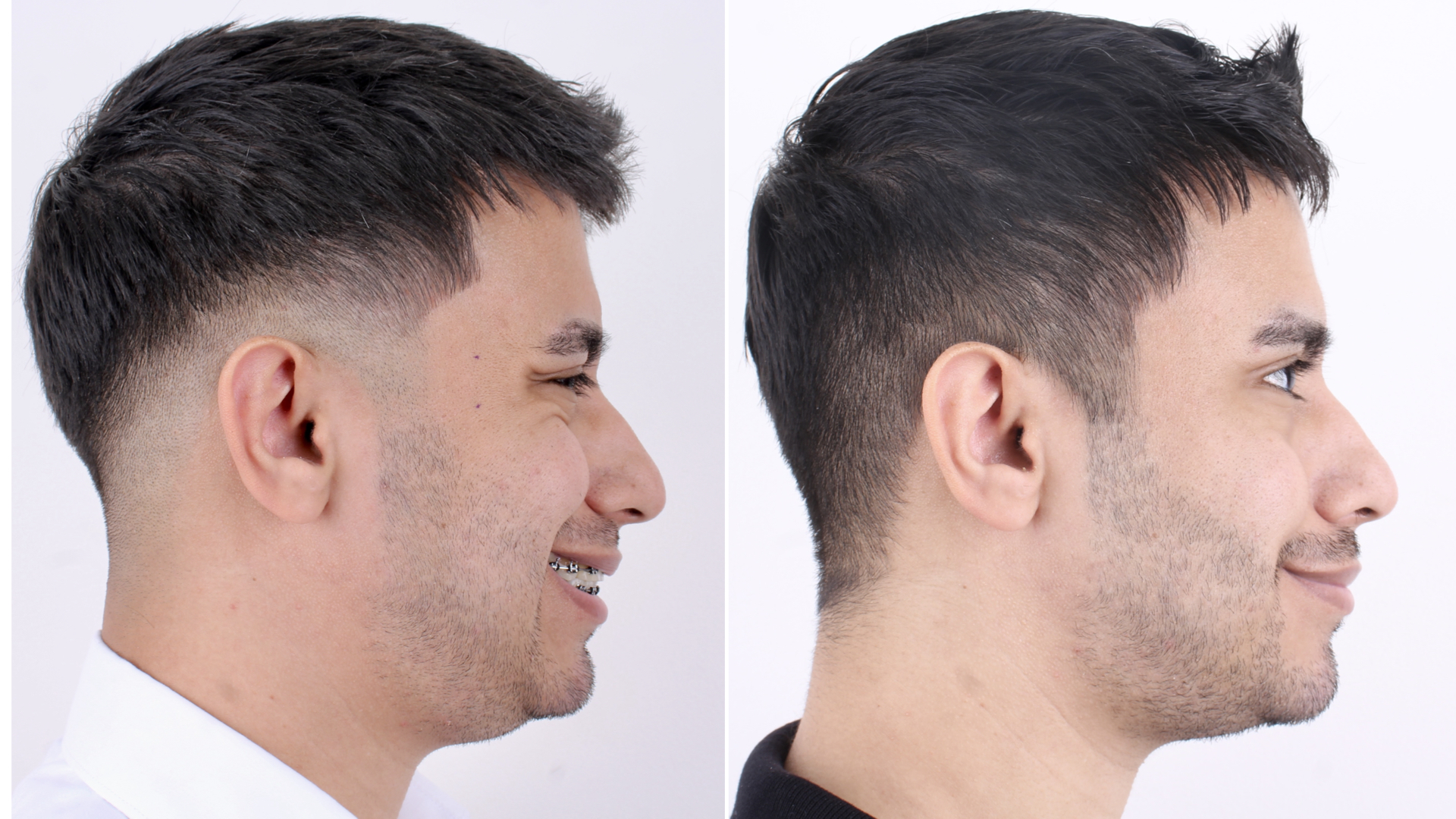 Antes y después · Liposucción Cervical · Perfil sonriendo antes y después: perfil armónico posquirúrgico.