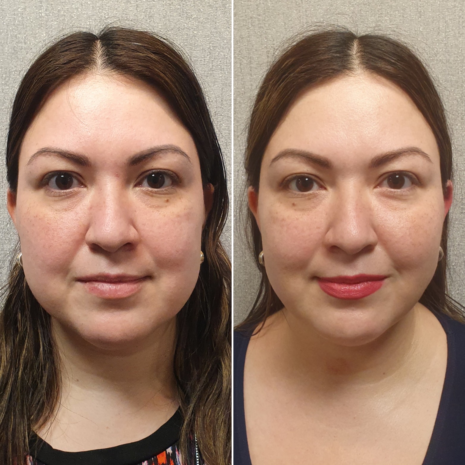 Antes y después · Liposucción Cervical · Frontal · resultado postoperatorio
